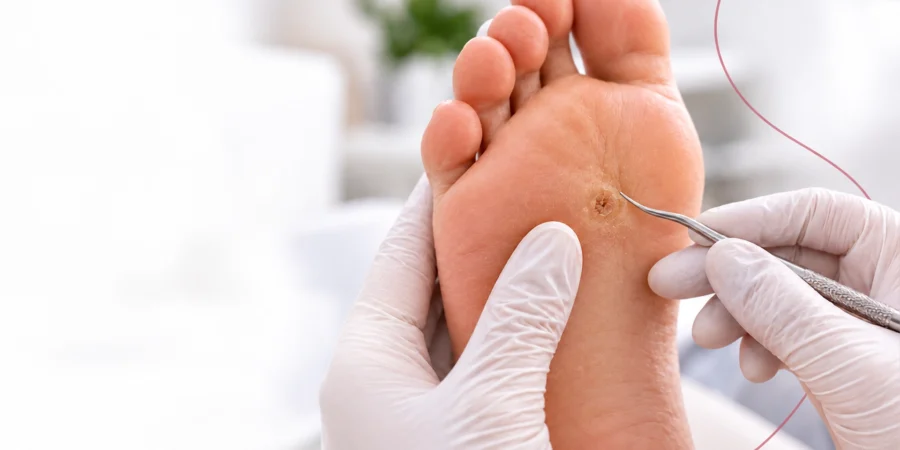 Tratamento especializado de verruga plantar realizado por profissional de podologia